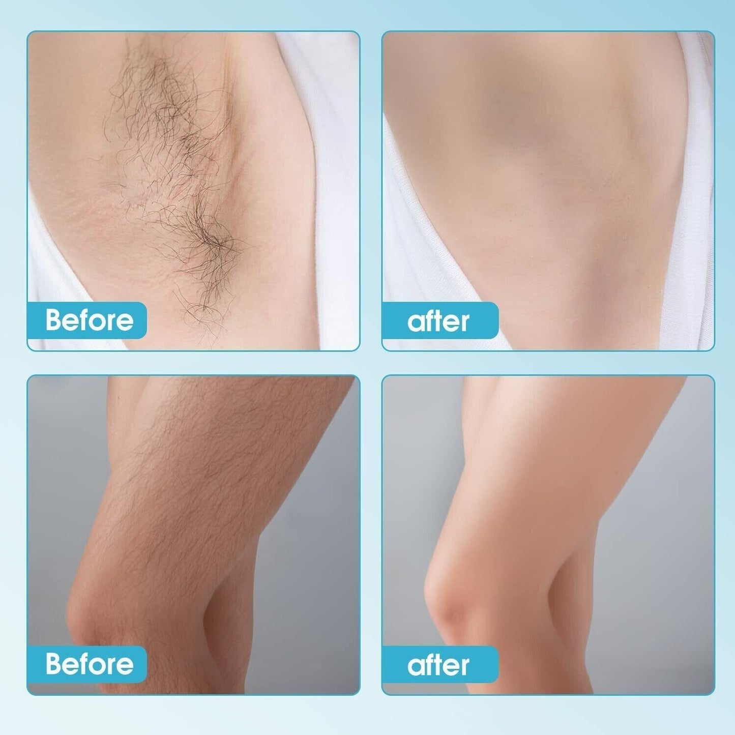 Hair Removal At-Home IPL Hair Removal for Women and Men Permanent